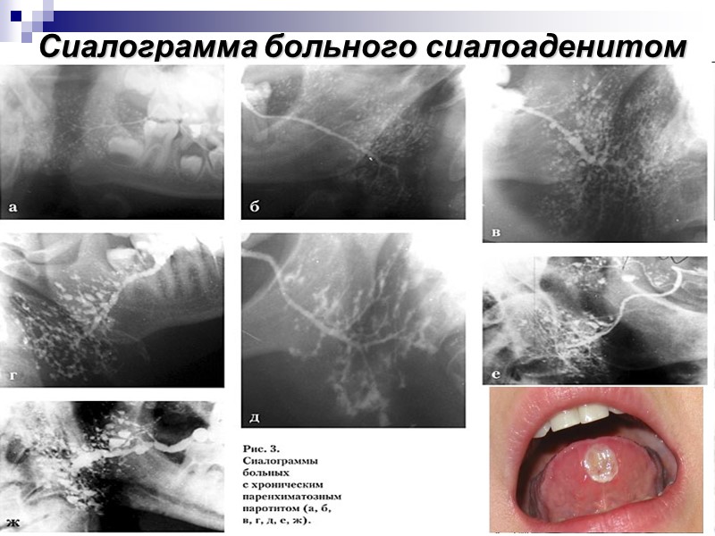 Сиалограмма больного сиалоаденитом